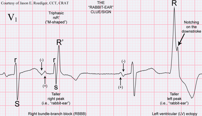 Rabbit Ear Sign ECG Guru Instructor Resources   Rabbit Ear 